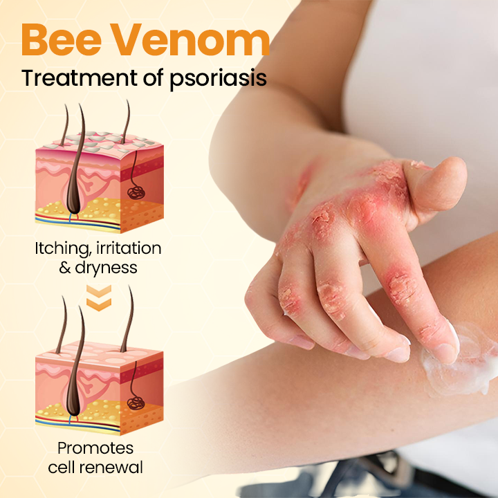 Timilk®BeeLieve Psoriasis Skin Care