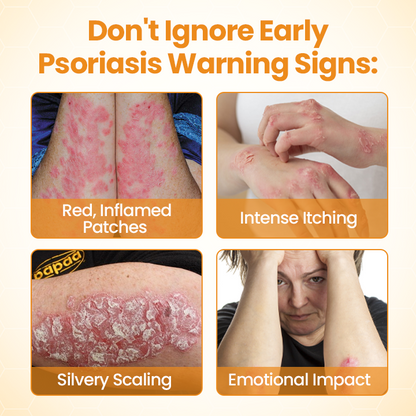 Timilk®BeeLieve Psoriasis Skin Care（new）