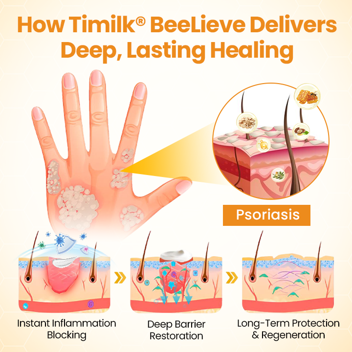 Timilk®BeeLieve Psoriasis Skin Care（new）