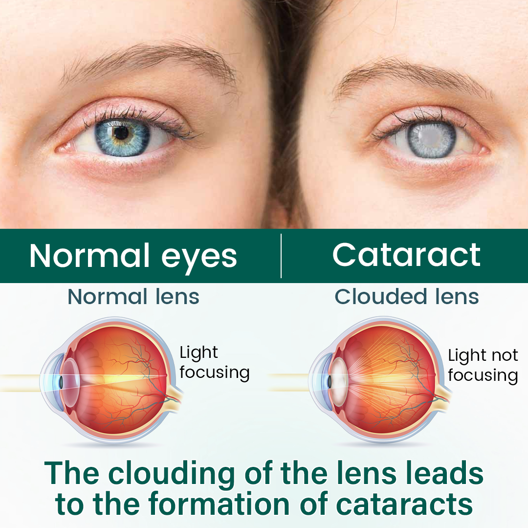Ceoerty® OptiClear Nano Eye Roller Serum
